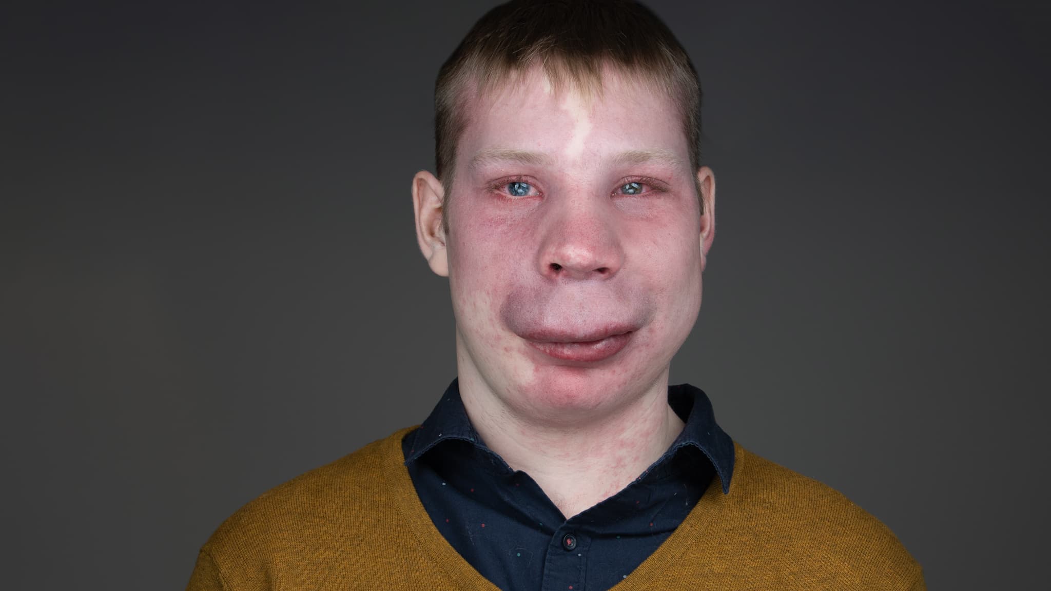 professional headshot of a young man with facial differences
